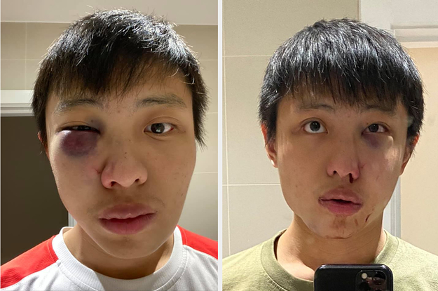 An Asian Student Said He Was Attacked On The Street Because Of Racism About The Coronavirus