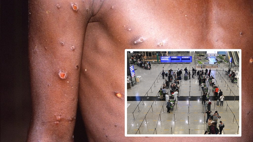 First suspected monkeypox case found in Hong Kong arrival