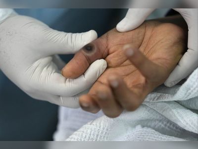 Are smallpox vaccines effective for monkeypox? Hong Kong research offers insight