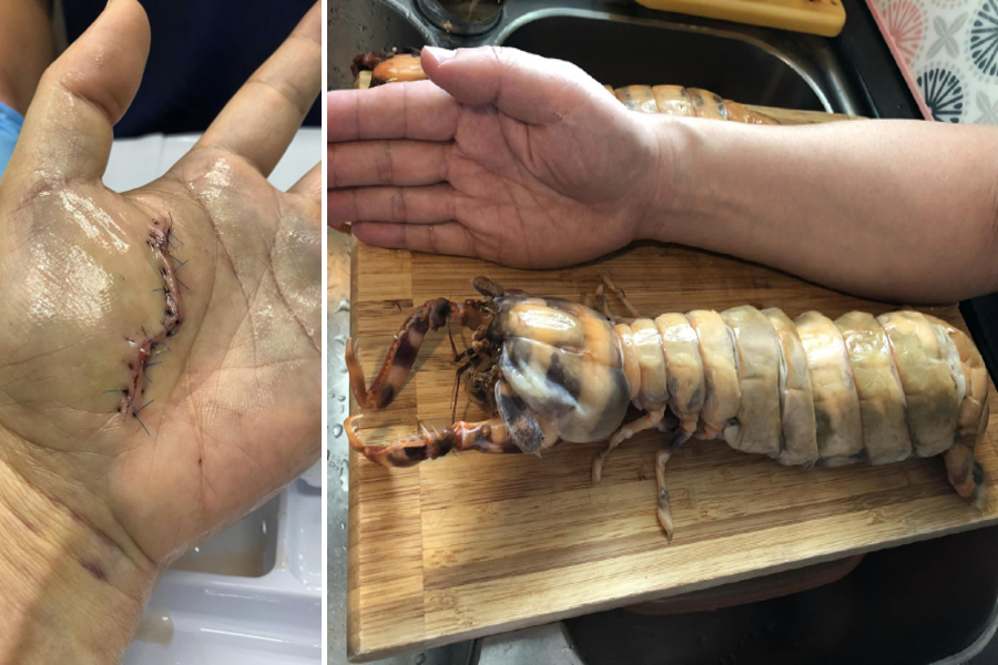 'Life lesson' of caution engraved on palm with scar left by mantis shrimp