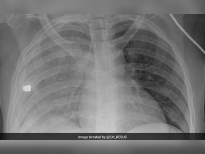 This X-Ray Scan Shows The Leading Cause Of Death In US Children