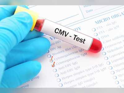 Hong Kong researchers suggest HCMV detection in urine as routine test for HIV-1 patients